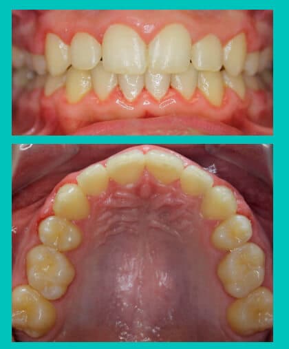 dental-crowding-image-after-coral-springs-fl
