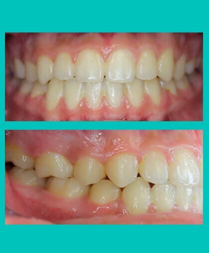 Completed orthodontic case