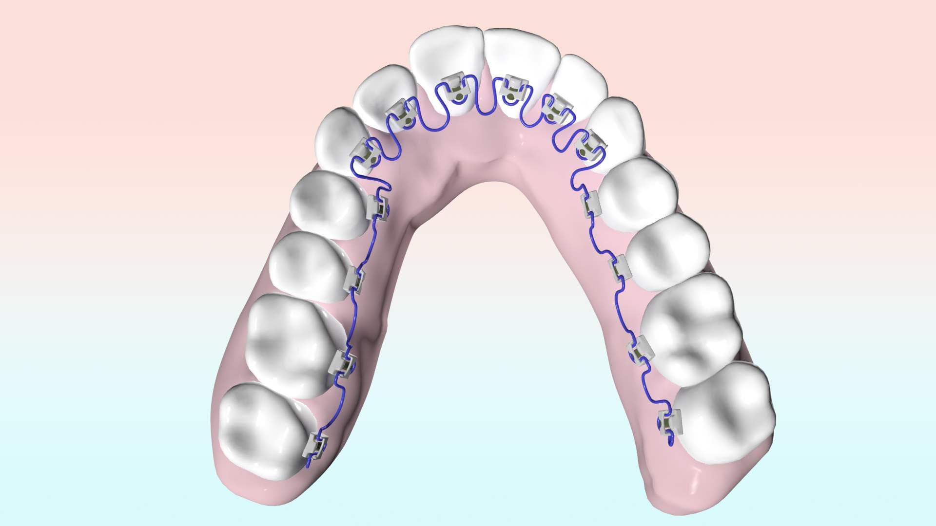 What are lingual braces?