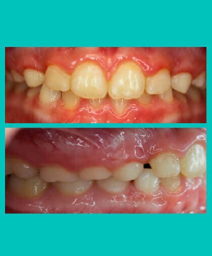 underbite-correction-image-coral-springs-fl-after