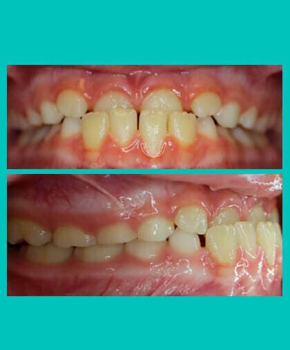 underbite-correction-image-coral-springs-fl-before