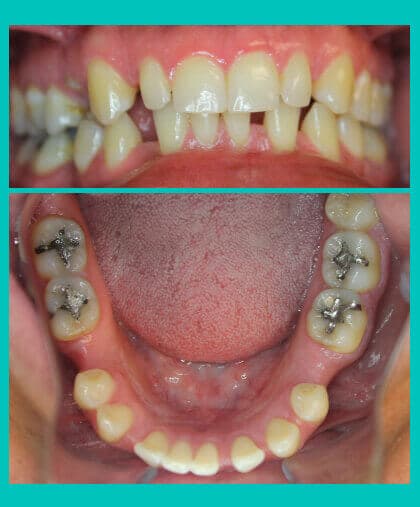 pre-prosethetic-orthodontics-image-coral-springs-fl-before